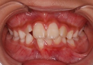 早期治療により非抜歯にて治療が完了できた小児の叢生(ガタガタの歯並び)症例。