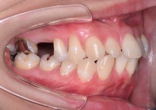上顎大臼歯部の欠損スペースを閉鎖した叢生をともなう成人の上下顎前突症例。