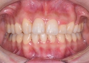 変則便宜抜歯にて矯正治療を行った叢生症例。