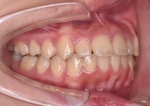 早期治療により永久歯非抜歯にて矯正治療が完了できた叢生(ガタガタの歯並び)症例。