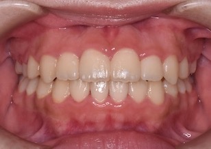 非抜歯にて矯正治療を行なった重度の開咬症例。