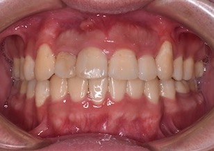 上顎大臼歯の欠損と下顎大臼歯の水平埋伏をともなう叢生症例。