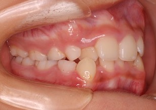 叢生(ガタガタの歯並び)の早期治療症例。
