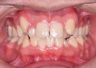 小臼歯便宜抜歯にて矯正治療を行なった重度の叢生症例。