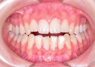 MFTを行い非抜歯にて矯正治療を行なった開咬症例。