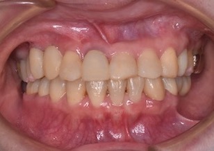 多数歯欠損をともなう成人の反対咬合症例。