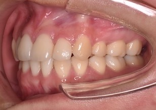 大臼歯部に交叉咬合を伴う叢生症例。