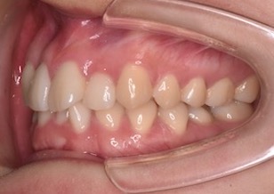 大臼歯部に交叉咬合を伴う叢生症例。