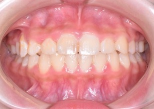 早期治療により永久歯非抜歯にて矯正治療が完了できた骨格性反対咬合症例。（上下顎歯列の叢生・臼歯部交叉咬合・埋伏犬歯を認める）