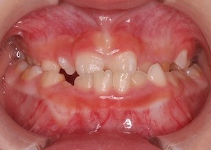 早期治療により永久歯非抜歯にて矯正治療が完了できた骨格性反対咬合症例。（上下顎歯列の叢生・臼歯部交叉咬合・埋伏犬歯を認める）